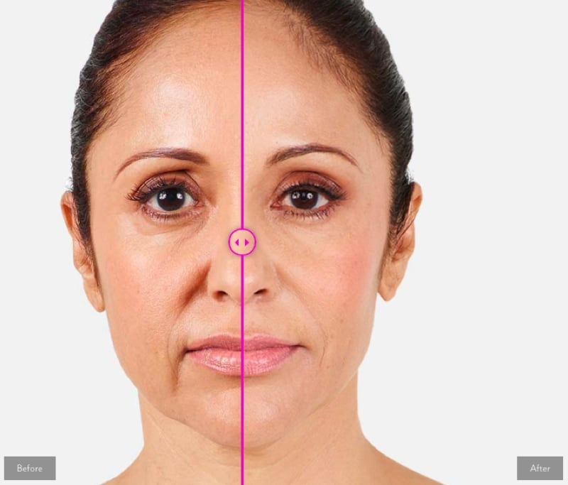 Surmunn behandling med botox Surmunn behandling med botox